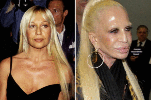 Famosos antes e depois das Plásticas