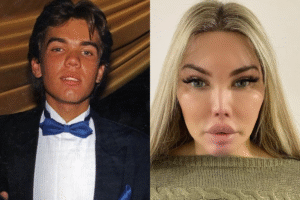 Famosos antes e depois das Plásticas